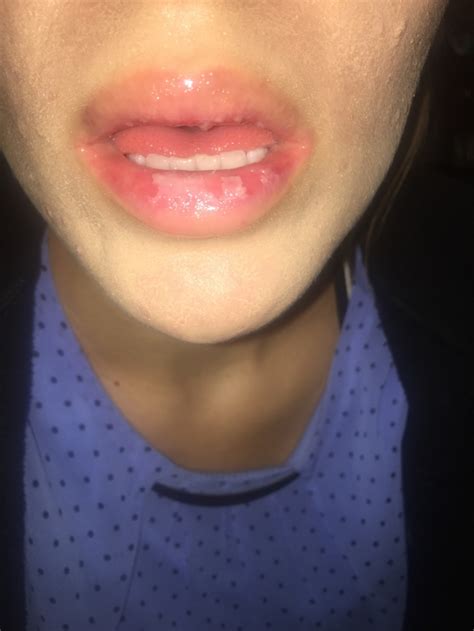 Raw Red Lips Please Help Accutane Isotretinoin Logs Forum
