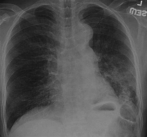 Lung Abscesses In 2 Patients With Lancefield Group F Streptococci