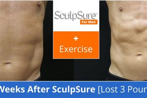 Sculpsure New Radiance Of Palm Beach
