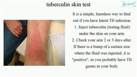Tuberculin Skin Test English Medical Terminology For Medical