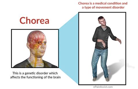 Huntington disease (hd) is a progressive disorder of motor, cognitive, and psychiatric disturbances. What is Chorea and How Can It Be Treated?