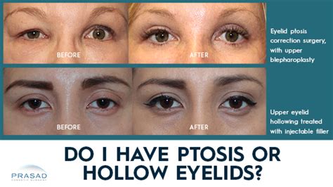 differences between eyelid ptosis and hollow upper eyelids video realself