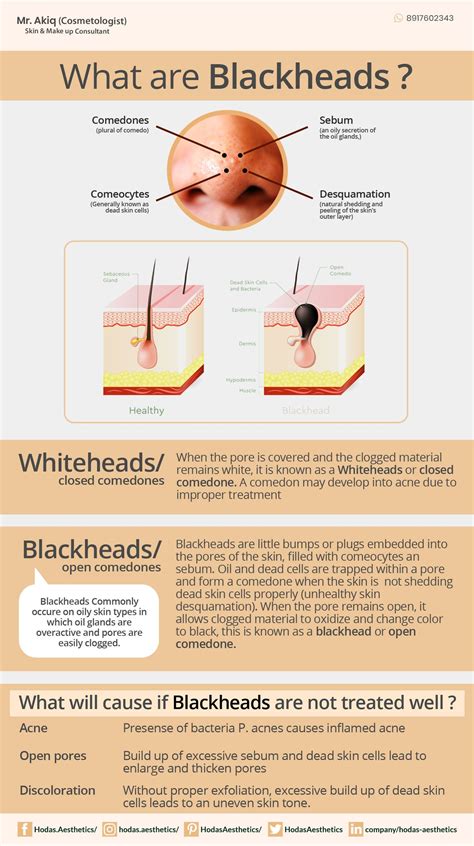 Blackheads And Whiteheads Are Both Types Of Clogged Pores That Develop