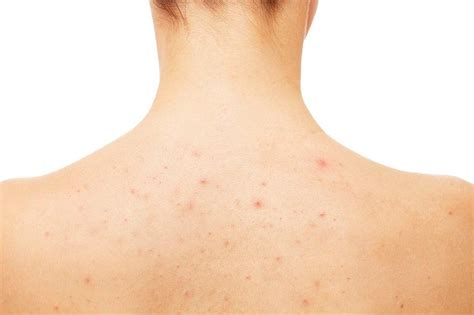 How To Get Rid Of Back Acne At Home 6 Best Ways Healthpulls