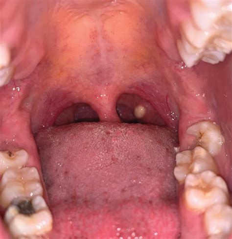 Unusual Site For A White Nodule On The Palatine Tonsil Presentation