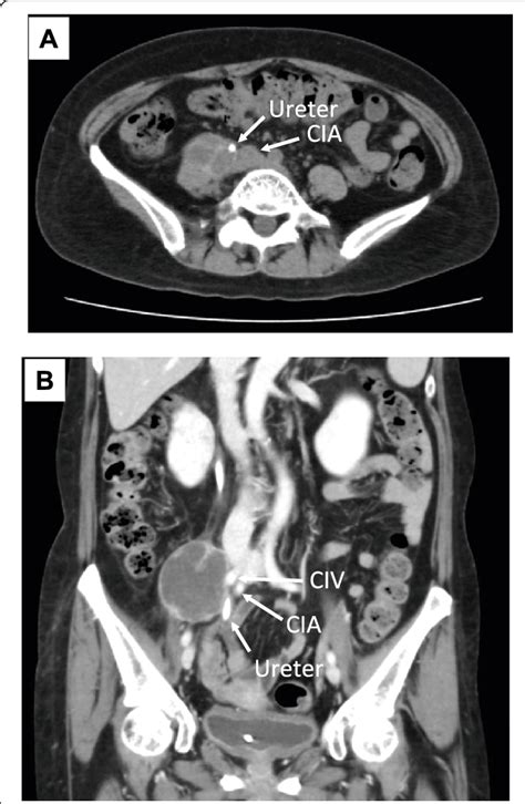 Ct Scans Of Retroperitoneal Tumors After 6 Courses Of Chemotherapy With