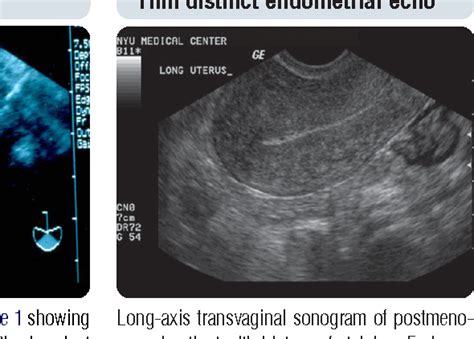 evaluation of the diagnostic role of transvaginal ultrasound my xxx hot girl