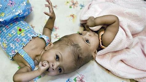 Twin Girls Joined At Head Separated By Uk Surgeons Cbc News