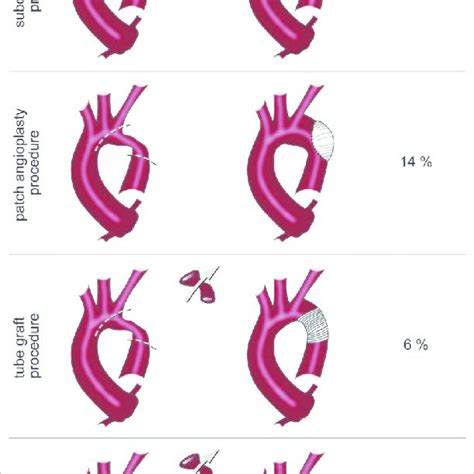 Anatomical Types Of Bicuspid Aortic Valve Bav According To A Classifi Download Scientific