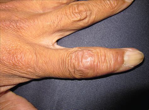 Subcutaneous Nodules On The Fingers—quiz Case Dermatology Jama