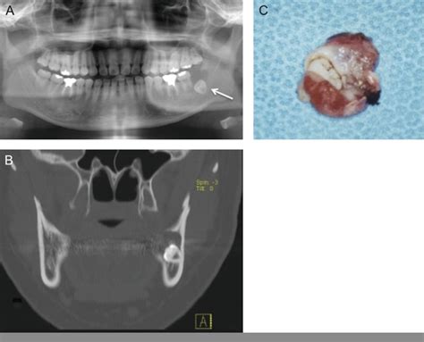 A Panoramic Radiography A Cystic Lesion With Wisdom Tooth Was Seen