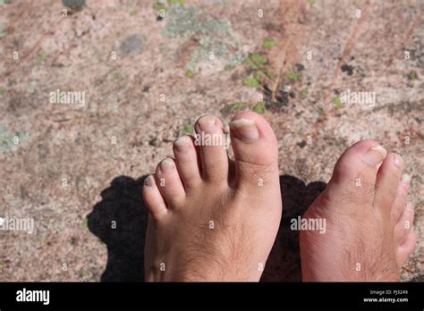 Closeup Of A Human Foot And Toes With Cracked And Peeling Toe Nails