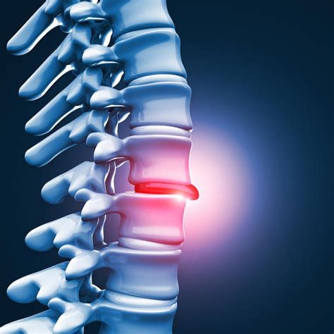 Warning Signs You Have A Herniated Disc John Regan Md Orthopedic Spine Surgeon