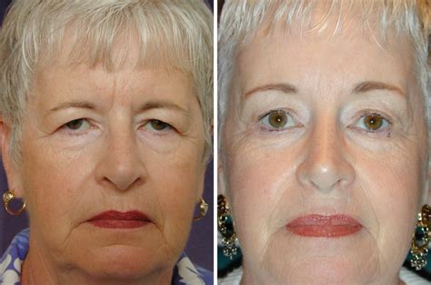 Eyelid surgery removes the excess tissue if you notice your eyelids are blocking your vision, you may be a candidate for upper eyelid surgery. Eyelid Surgery: Cosmetic Procedure to Rejuvenate Eyes ...