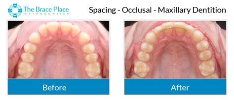 Occlusal Photo Of Maxillary Dentition The Brace Place Orthodontics