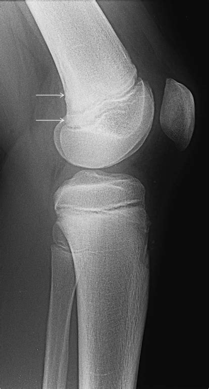 Distal Femoral Cortical Irregularity In An Adolescent Eurorad
