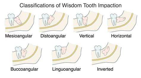 Wisdom Teeth Extraction Without Private Health Insurance Raustralia