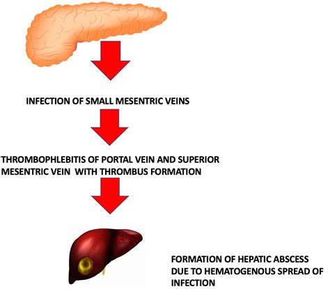 Cureus Pylephlebitis With Hepatic Abscess Complicating A Case Of