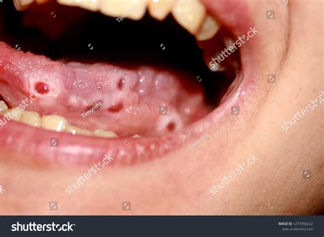 Ulcer Under Tongue
