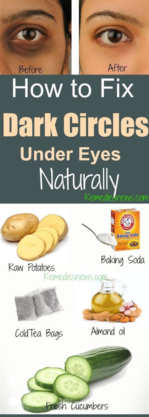 You can get these bands online. How to Fix Dark Circles Under Eyes Naturally at Home Fast ...