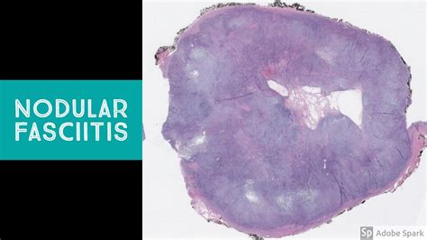 Nodular Fasciitis Explained By A Soft Tissue Pathologist Youtube