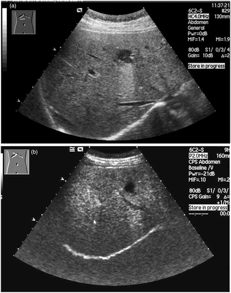 Ultrasound Of The Liver With And Without Contrast A Grayscale Download Scientific Diagram