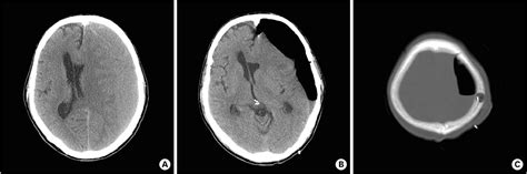 Burr Hole Drainage Versus Small Craniotomy Of Chronic Subdural Hematomas