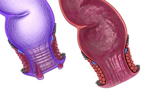 Human Anatomy Rectum And Hemorrhoids 3d Model Cgtrader