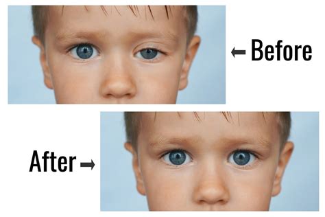 Congenital Ptosis In Babies Causes Symptoms And Treatment Being