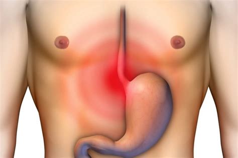 O que é esofagite Entenda quais são suas causas e os tratamentos