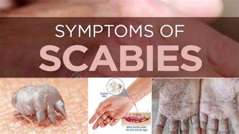 Cara Mengobati Kudis Atau Scabies Dr Jeffry Youtube