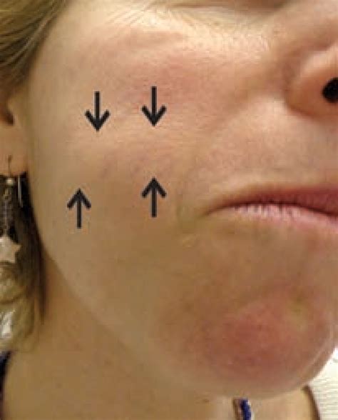 Horizontal Longitudinal Swelling Involving Buccal Soft Tissues Of Face