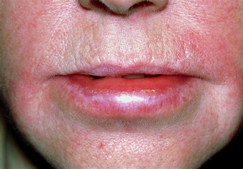 Angioedema Of The Lips Due To An Allergic Reaction Photograph By Dr P