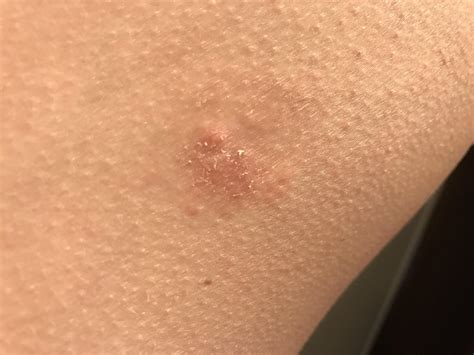 Patch Of Flaky Skin On Face