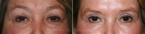 Blepharoplasty Photos Chevy Chase Md Patient 12662