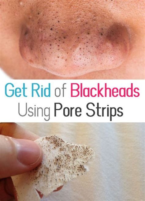 How To Get Rid Of Blackheads Completely Using Pore Strips Nose Strips