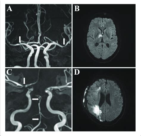 Mr Angiography Of 2 Patients With Cerebral Vasculitis Mr Angiography