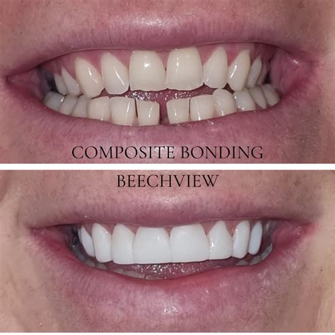 Composite Bonding Dental Bonding Teeth Bonding Beechview Dental