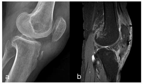 Medicina Free Full Text Isolated Avulsion Fracture Of The Tibial