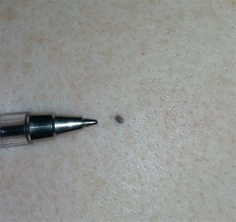 Small Black Spot Found On Upper Back Cancer Forums Patient