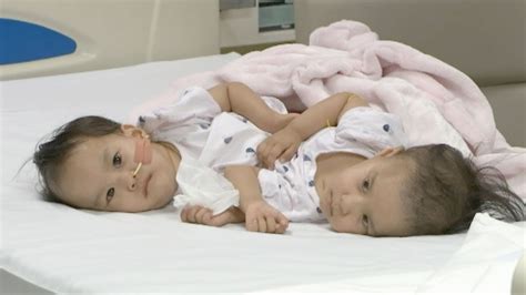Bhutanese Conjoined Twins Successfully Separated In Marathon Surgery