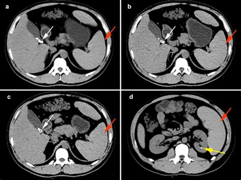 Abdominal And Pelvic Ct Scans Showed Multiple Gallstones White Arrows