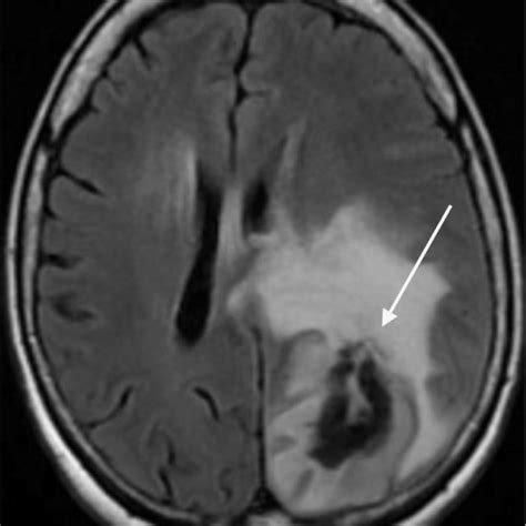 Mri Of The Brain Mri Of The Brain Showing A Hemorrhagic Mass Within