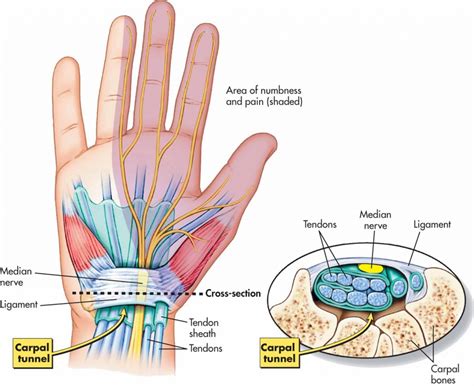Carpal Tunnel Syndrome - Hand - Orthobullets