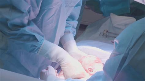 Surgical Team Performing Surgery Operation Stock Footage Sbv