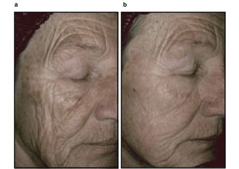 Case Example Of A Subject Treated With Tretinoin Emollient Cream 005