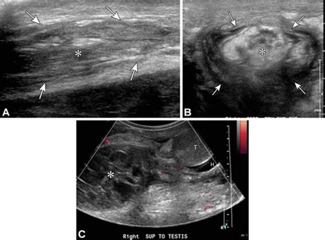 Pathologic Conditions At Imaging Of The Spermatic Cord Radiographics