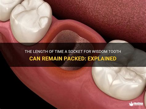 The Length Of Time A Socket For Wisdom Tooth Can Remain Packed
