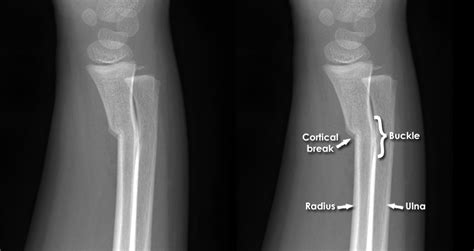 Trauma X Ray Upper Limb Gallery 1 Greenstick And Torus Fractures