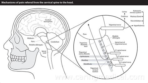 Cluster Headaches Neck Instability And The Trigeminal And Vagus Nerves